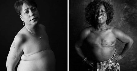 אני עדיין אישה למרות שאיבר מסוים בגוף שלי חסר: פרויקט צילום מרגש