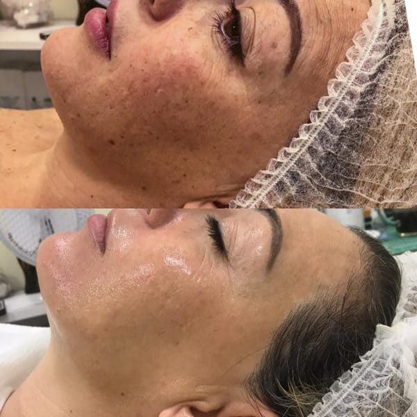 תמונות לפני ואחרי מהקליניקה של טניה אוהב שלום