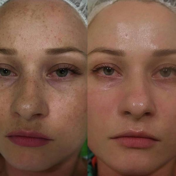 תמונות לפני ואחרי מהקליניקה של טניה אוהב שלום